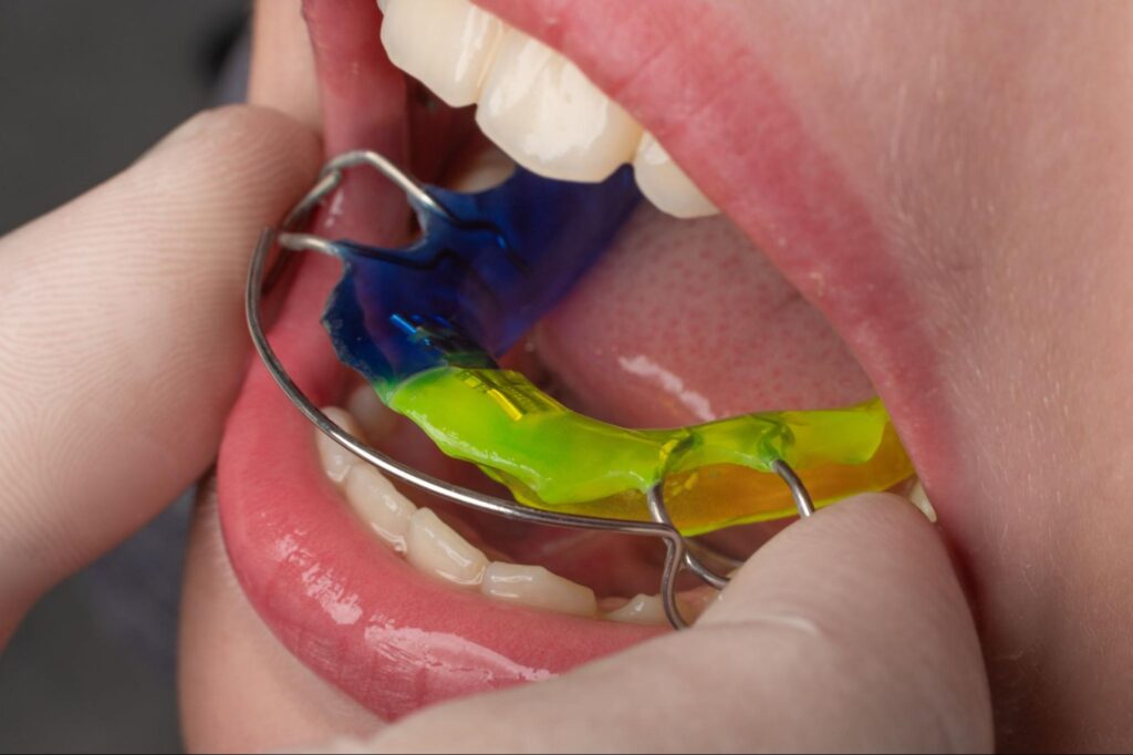 What Should I Do If I Lose Or Damage My Retainers?