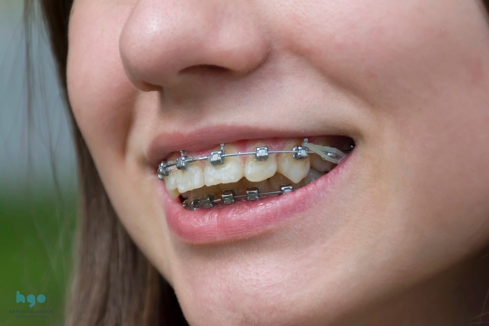Smiling girl with metal braces showcasing orthodontic treatment for overbite correction, relevant to Charlottesville family orthodontist services.