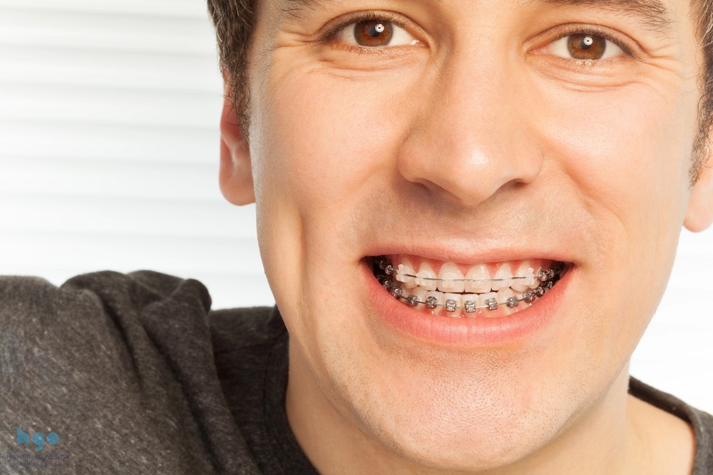 happy young man with metal braces - Overbite vs Underbite in Charlottesville, VA.