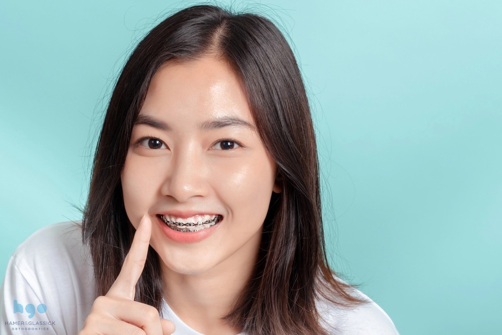 dental braces young asian woman wearing metal braces beauty smile - How to Get Braces Glue Off Teeth in Charlottesville, VA